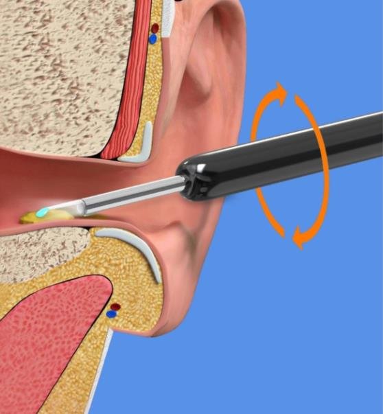 Mediplus360 - Visual Otoscope Ear Wax Removal